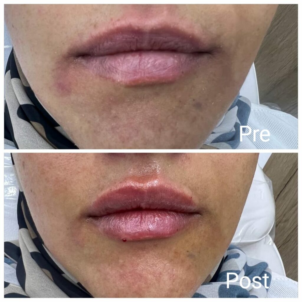 Lip contouring filler in Hurghada